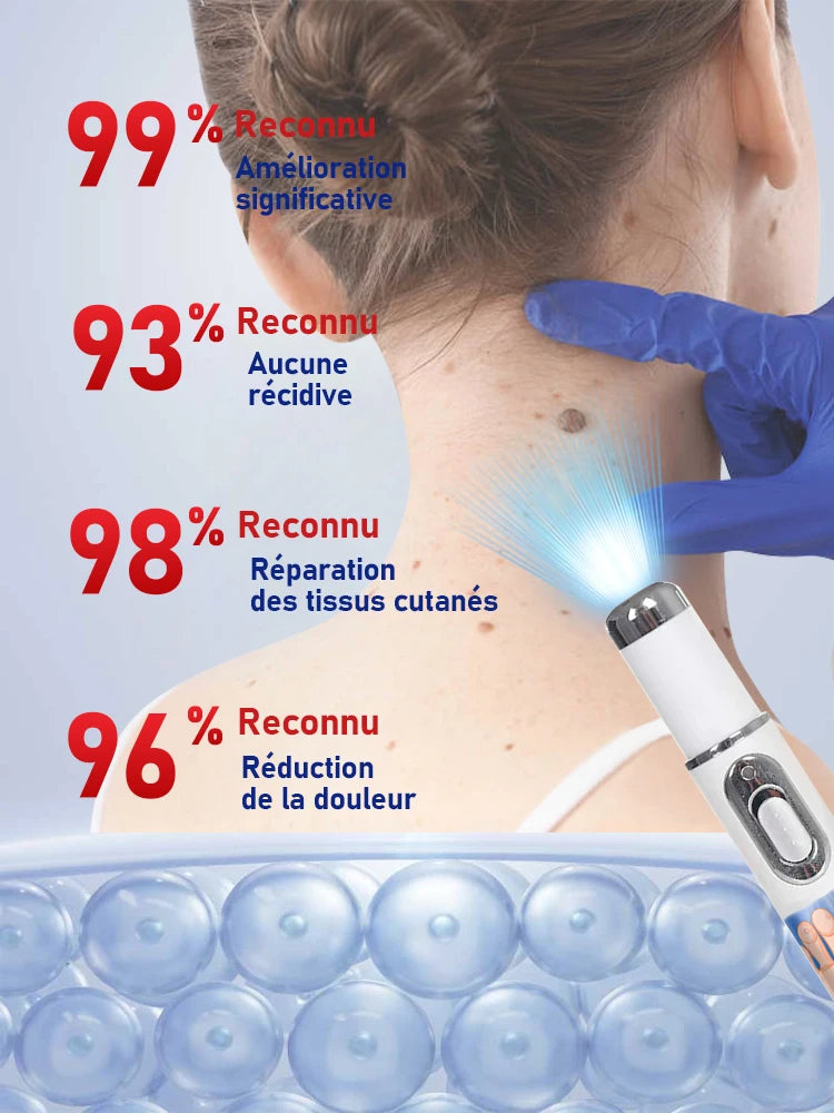 Stylo Laser Lumière Bleue Anti-Verrues | Dernière Génération | Efficacité +50% – CLEVI Paris
